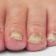 schimmel en kalk nagels behandelen