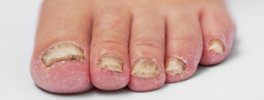 schimmel en kalk nagels behandelen